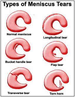 Types-of-meniscus